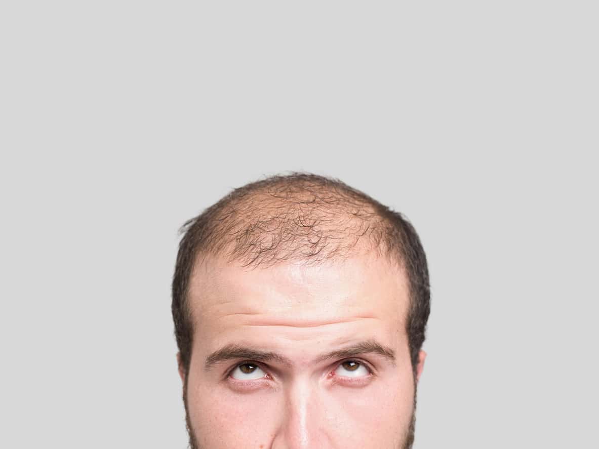 How Hormone Replacement Therapy Can Stop and Reverse Hair Loss | BodyLogicMD How Hormone Replacement Therapy Can Stop and Reverse Hair Loss | BodyLogicMD